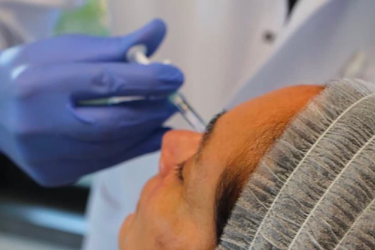 Mesoterapia Facial: Benefícios, Resultados e Número de Sessões