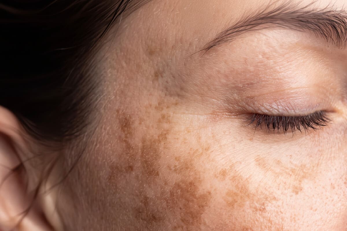 Melasma: Como a Terapia Fotobiodinâmica Pode Ajudar nas Manchas